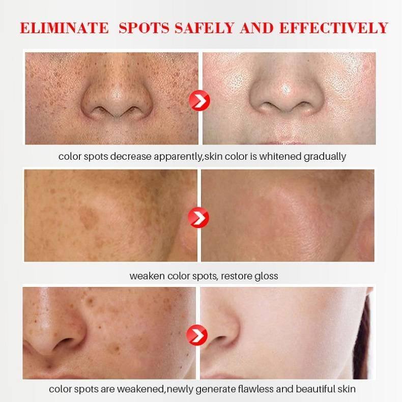 Effective Whitening Freckle Cream Remove Melasma Acne Spot Pigment Melanin Dark Spots Pigmentation Moisturizing Gel Skin Care