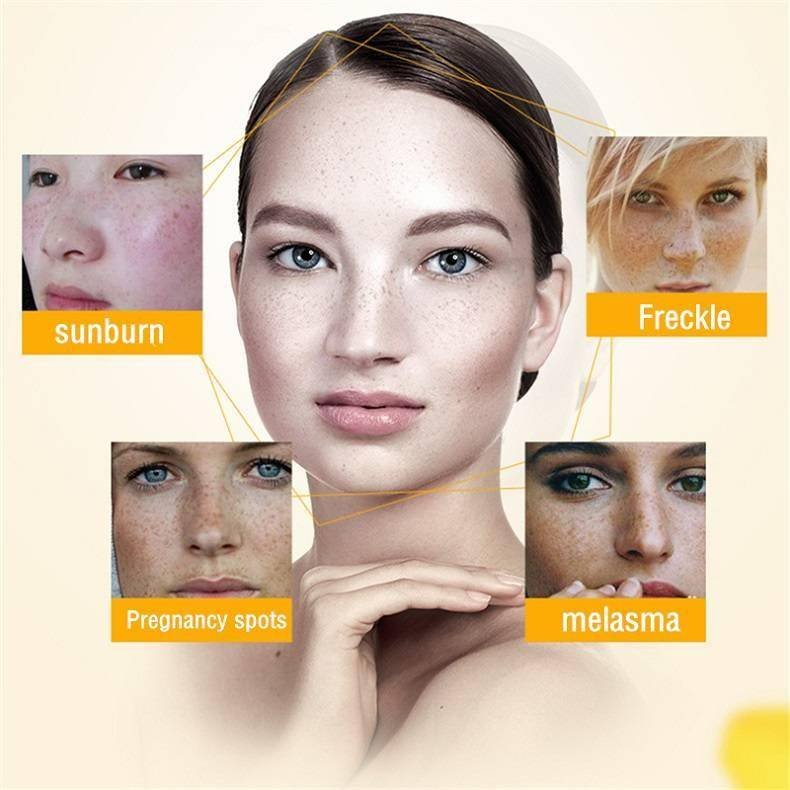 Effective Whitening Freckle Cream Remove Melasma Acne Spot Pigment Melanin Dark Spots Pigmentation Moisturizing Gel Skin Care