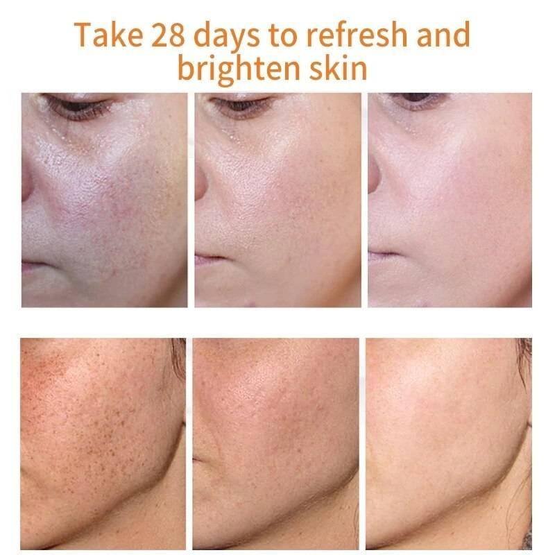 Effective Whitening Freckle Cream Remove Melasma Acne Spot Pigment Melanin Dark Spots Pigmentation Moisturizing Gel Skin Care Best Sellers Effective Whitening Freckle Cream Remove Melasma Acne Spot Pigment Melanin Dark Spots Pigmentation Moisturizing Gel Skin Care Best Sellers http://gotoptrend.com/effective-whitening-freckle-cream-remove-melasma-acne-spot-pigment-melanin-dark-spots-pigmentation-moisturizing-gel-skin-care/ http://gotoptrend.com Go Top Trend