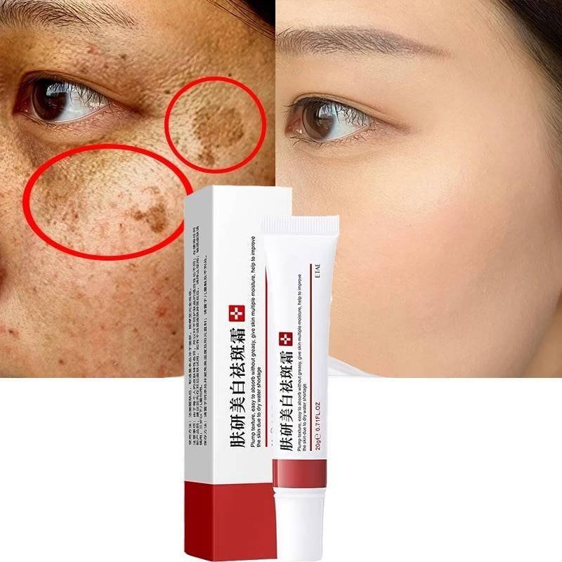 Effective Whitening Freckle Cream Remove Melasma Acne Spot Pigment Melanin Dark Spots Pigmentation Moisturizing Gel Skin Care Best Sellers Effective Whitening Freckle Cream Remove Melasma Acne Spot Pigment Melanin Dark Spots Pigmentation Moisturizing Gel Skin Care Best Sellers http://gotoptrend.com/effective-whitening-freckle-cream-remove-melasma-acne-spot-pigment-melanin-dark-spots-pigmentation-moisturizing-gel-skin-care/ http://gotoptrend.com Go Top Trend