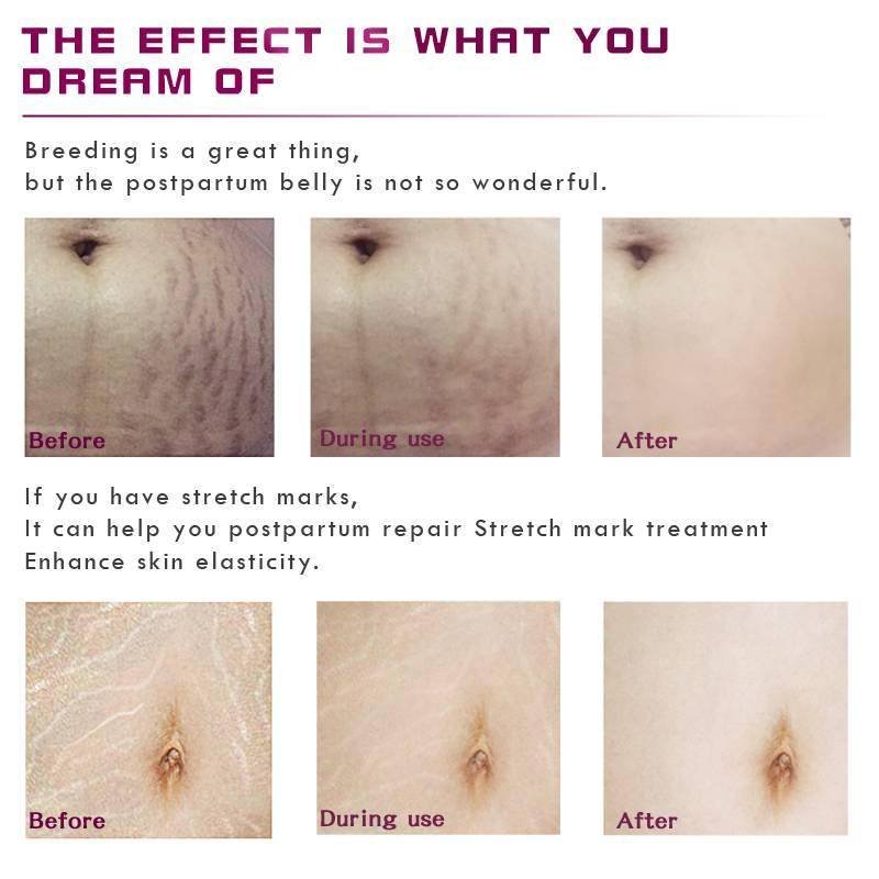 Stretch Marks Remover Essential Oil Skin Care Treatment Cream For Stretch Mark Removal Maternity Slackline For Pregnant Oils Stretch Marks Remover Essential Oil Skin Care Treatment Cream For Stretch Mark Removal Maternity Slackline For Pregnant Oils