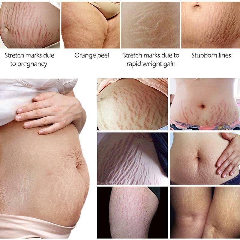 Stretch Marks Remover Essential Oil Skin Care Treatment Cream For Stretch Mark Removal Maternity Slackline For Pregnant Oils Stretch Marks Remover Essential Oil Skin Care Treatment Cream For Stretch Mark Removal Maternity Slackline For Pregnant Oils