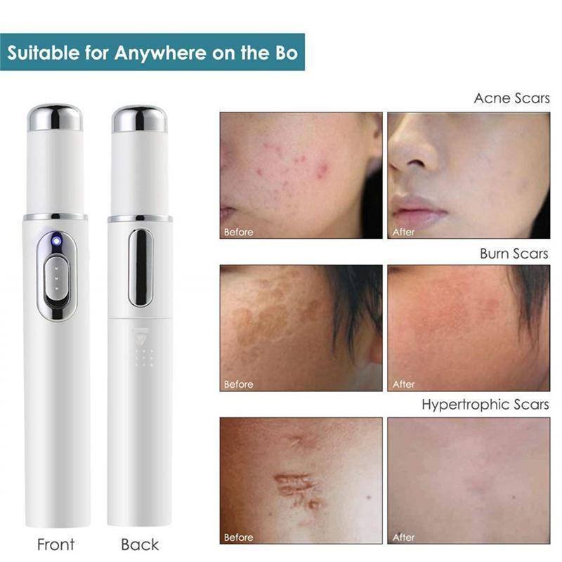 Heath Blue Light Therapy Varicose Veins Treatment Laser Pen Soft Scar Wrinkle Removal Treatment Acne Laser Pen Massage Relax BEAUTY AND HEALTH Best Sellers Women Clothing & Erotic Lingerie Heath Blue Light Therapy Varicose Veins Treatment Laser Pen Soft Scar Wrinkle Removal Treatment Acne Laser Pen Massage Relax BEAUTY AND HEALTH Best Sellers Women Clothing & Erotic Lingerie http://gotoptrend.com/heath-blue-light-therapy-varicose-veins-treatment-laser-pen-soft-scar-wrinkle-removal-treatment-acne-laser-pen-massage-relax/ http://gotoptrend.com Go Top Trend