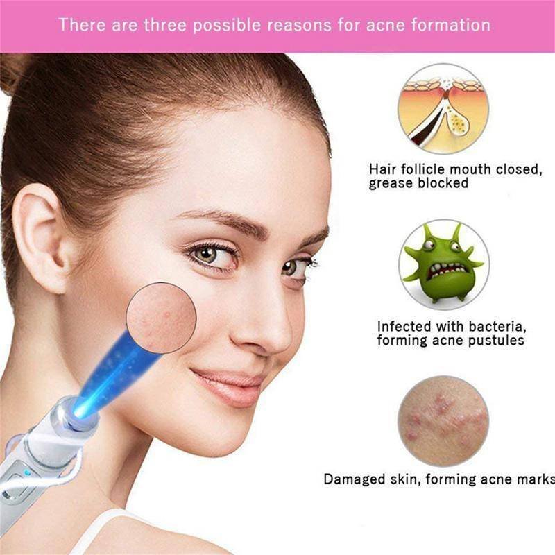 Heath Blue Light Therapy Varicose Veins Treatment Laser Pen Soft Scar Wrinkle Removal Treatment Acne Laser Pen Massage Relax BEAUTY AND HEALTH Best Sellers Women Clothing & Erotic Lingerie Heath Blue Light Therapy Varicose Veins Treatment Laser Pen Soft Scar Wrinkle Removal Treatment Acne Laser Pen Massage Relax BEAUTY AND HEALTH Best Sellers Women Clothing & Erotic Lingerie http://gotoptrend.com/heath-blue-light-therapy-varicose-veins-treatment-laser-pen-soft-scar-wrinkle-removal-treatment-acne-laser-pen-massage-relax/ http://gotoptrend.com Go Top Trend